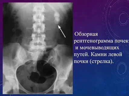Конкремент правой