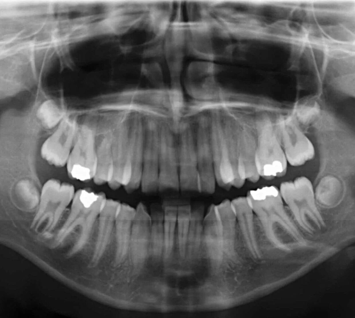 Снимок зубов видное. Ортопантомограмма челюсти. Ортопантомограмма кариес. ОПТГ кариес снимок зубов.
