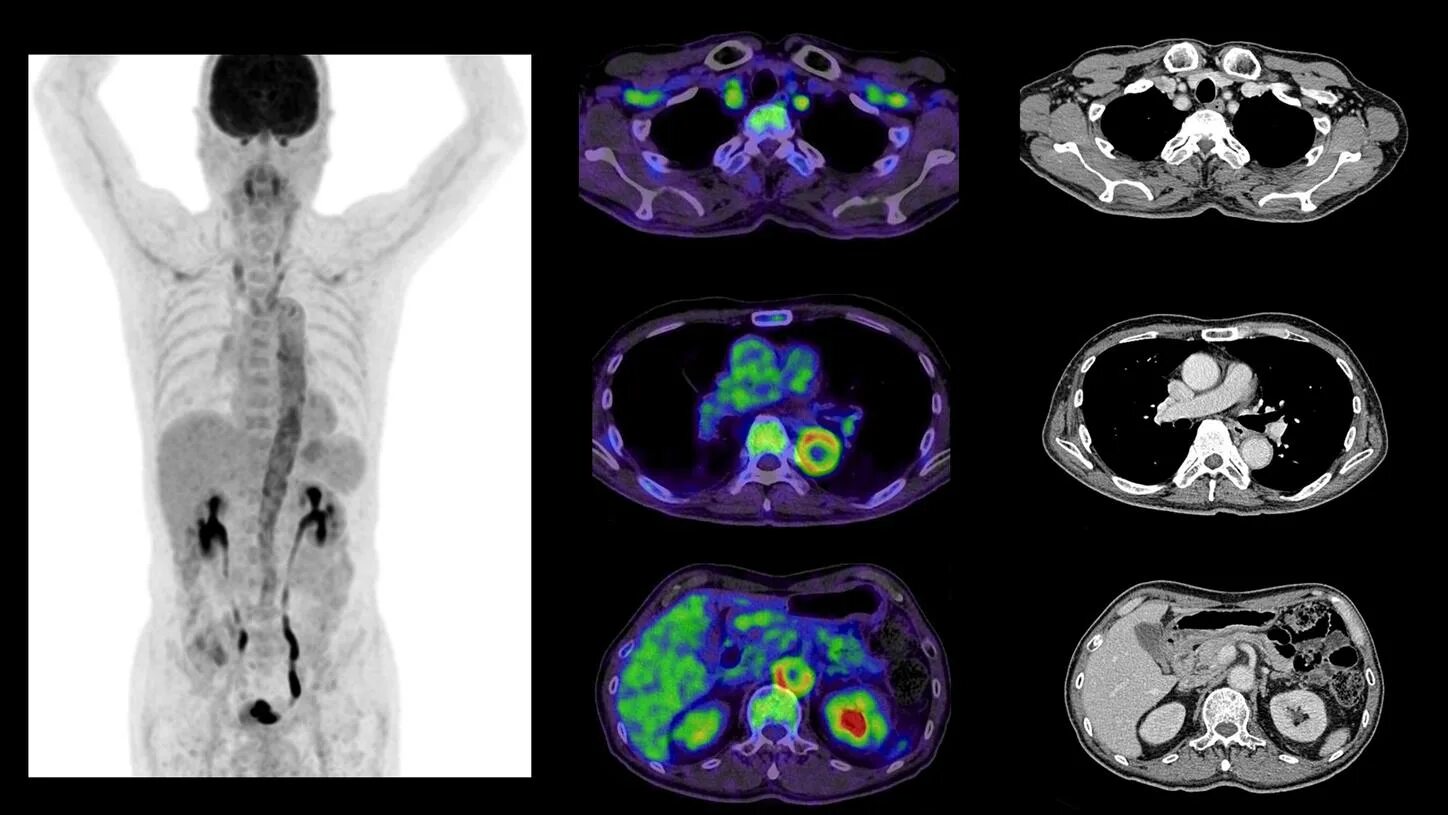 Кт после химиотерапии. ПЭТ кт Pet CT. Артефакты мрт.