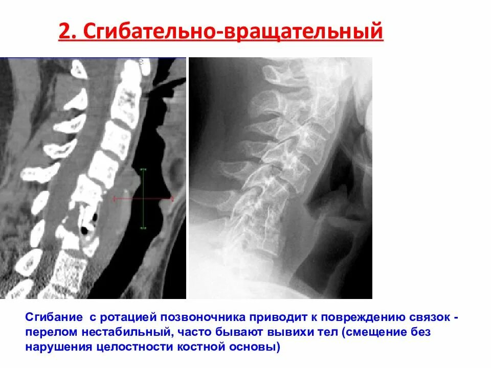 Флексионно дистракционный перелом позвоночника. Клиновидный компрессионный перелом позвоночника. Сгибательный перелом позвоночника. Сгибательный перелом тела позвонка.