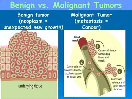 Metastasis