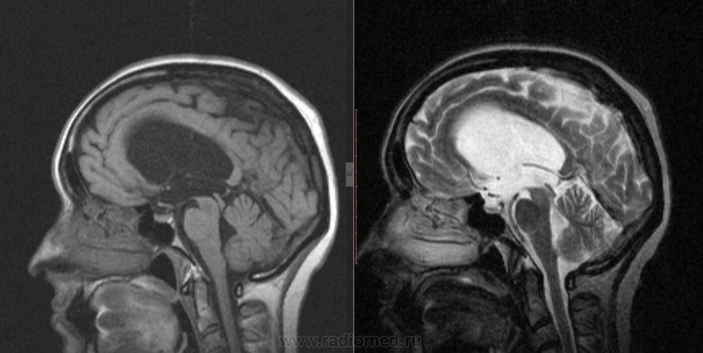 Выраженная заместительная гидроцефалия. Гидроцефалия головного мозга мрт. Первичная риногенная гидроцефалия.