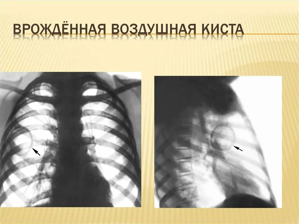 Врожденные кисты легких. Бронхогенная киста рентгенограмма. Нагноившаяся киста легкого. Врожденная киста легкого рентген. Врожденные кисты легких.