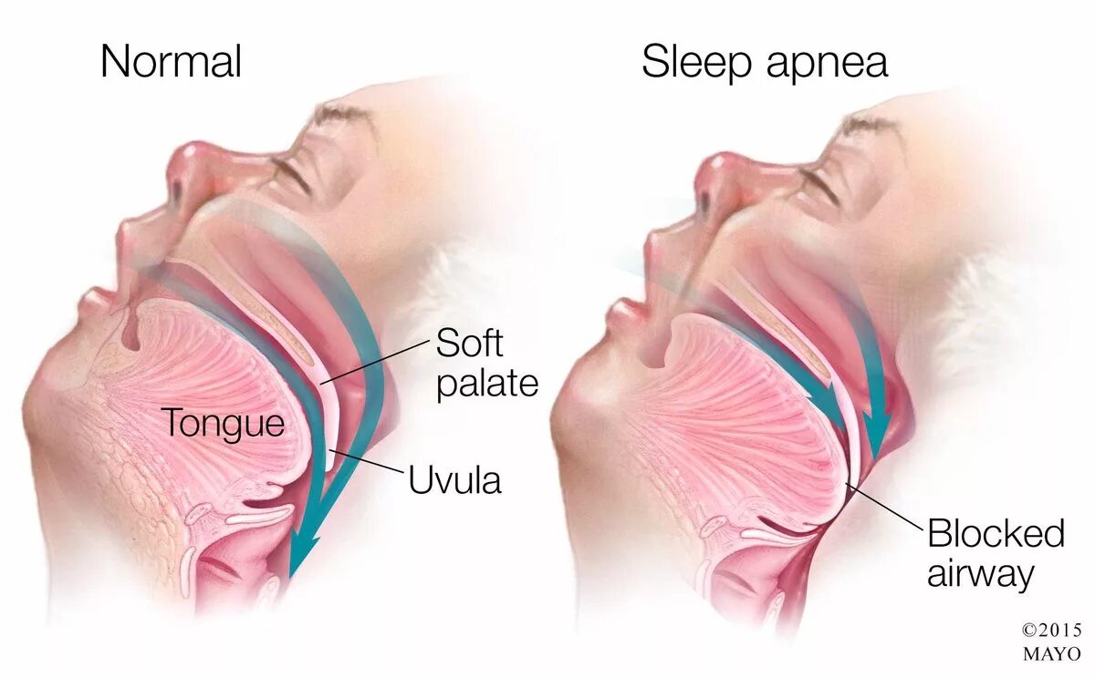Заболевание апноэ во сне. Синдром обструктивного апноэ сна. Синдром остановки дыхания во сне. Обструктивное ночное апноэ.
