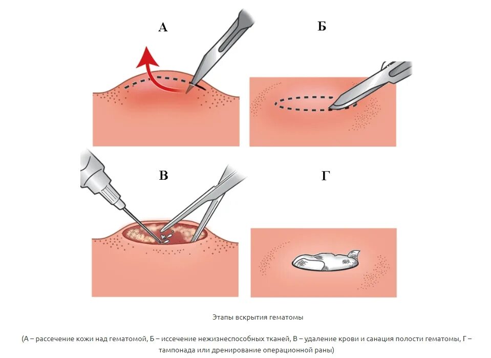 Через сколько снимать дренаж. Вскрытие подкожной гематомы. Хирургический дренаж для фурункула.