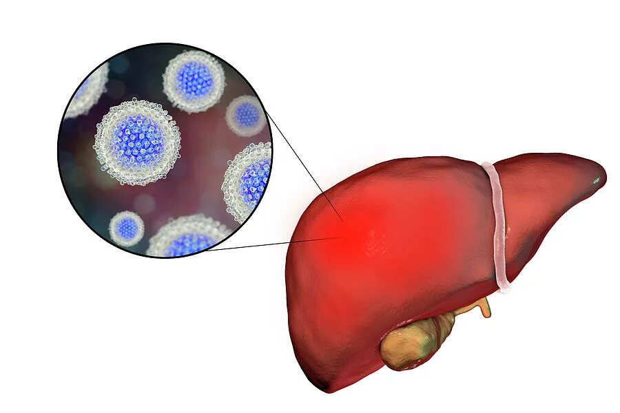 Вирусный гепатит печень. Вирус гепатита в.