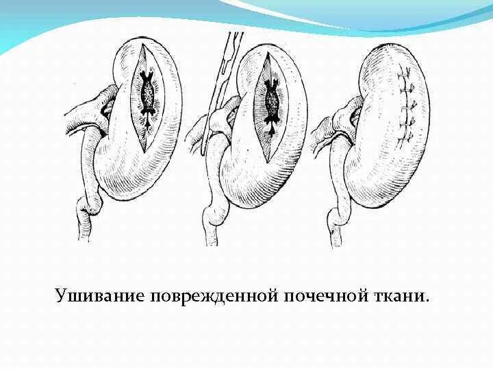 Основные виды нарушения мочевыделения. Нарушение процесса мочевыделения последствия. Источник развития нефрогенной ткани. Основные причины нарушения мочевыделения