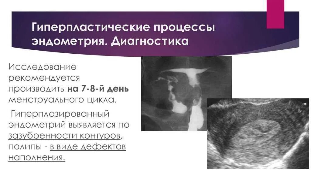 Эндометрия матки причины возникновения. Атипическая гиперплазия эндометрия узи. гиперпластические процессы эндометрия диагностика. железистая гиперплазия эндометрия узи.