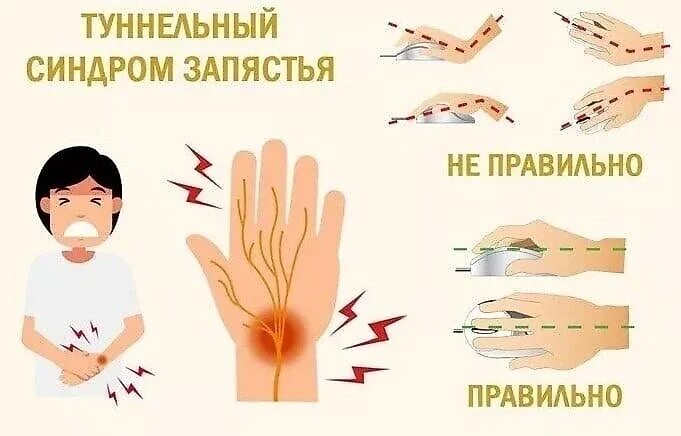 Онемение рук синдром. Запястный туннельный синдром. болезнь кисти руки туннельный синдром. тонельныйтонельный синдром. туннельная синдром кист.