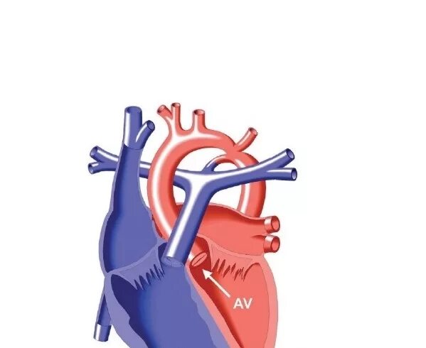 перерыв дуги аорты