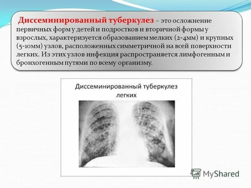 Род туберкулеза. Хронический диссеминированный туберкулез. Острый диссеминированный туберкулез клиника. Диссеминированный туберкулез симптомы. Острый диссеминированный туберкулез классификация.