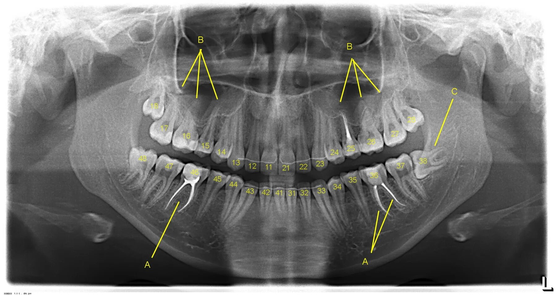 Снимок зубов видное. Ортопантомография пародонтит. Ортопантомограмма периостит. Ортопантомограмма (ОПТГ).