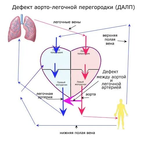 Дефект аортолегочной перегородки тест нмо. Типы дефекта аорто-легочной перегородки. дефект перегородки между аортой и легочной артерией. дефект аорто-лёгочной перегородки. дефект аортолегочной перегородки на эхокг.
