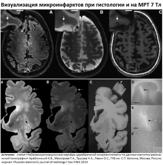 Микроангиопатия головного мозга fazekas. Микроангиопатии сосудов головного мозга. Амилоидная ангиопатия кт. Амилоидная микроангиопатия. Микроангиопатии головного мозга мрт.