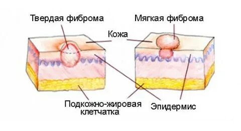 Доброкачественное новообразование жировой ткани кожи