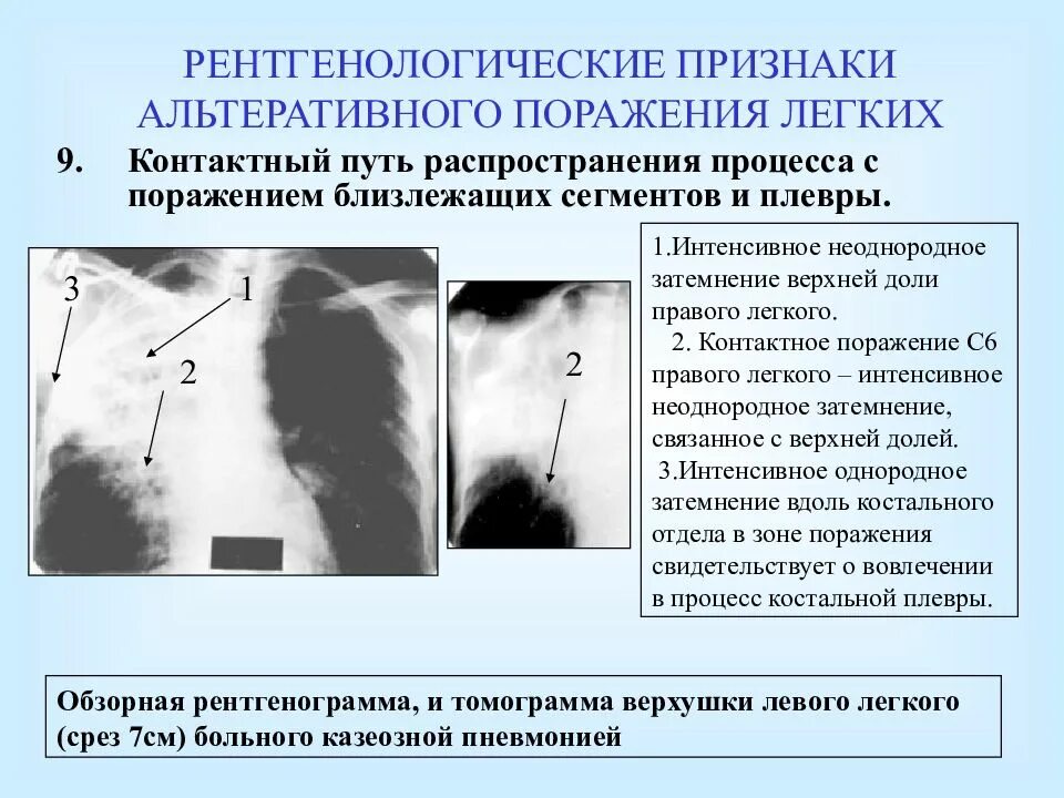 Поражен легких 3. Признаки поражения легких. Симптомы поражён лёгких. Поражение лёгких симптомы. Признаки поражения лёгкого.