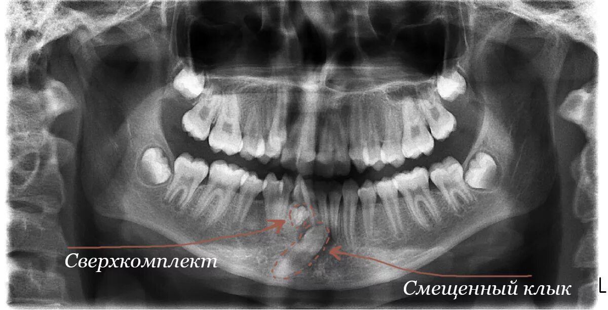 Аномалии удаления. Аномалия зубная сверхкомплектные. Сверхкомплектные резцы верхней челюсти. Сверхкомплектные зубы рентген. Сверхкомплектные зубы аномалия.