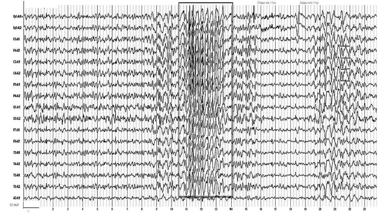 Ээг глаза. ЭЭГ при ЗЧМТ. Десинхронизация ЭЭГ. Vertex волна ЭЭГ. ЭЭГ при закрытых глазах.