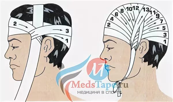 Алгоритм чепца. Бинтовая повязка чепец. десмургия повязка чепец. повязка чепец схема. чепец повязка на голову алгоритм.