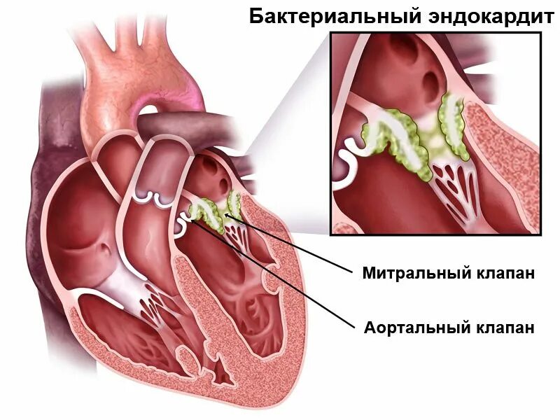 Эндокардит поражающий аортальный клапан. Септический эндокардит митрального клапана. Митральный клапан и аортальный клапан. Инфекционный эндокардит аортального клапана. Вегетация у детей