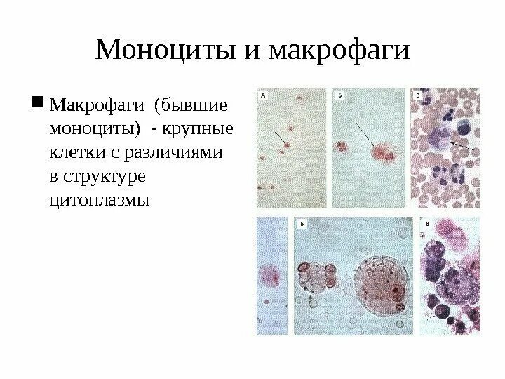 Ликвор клетки макрофаги. Макрофаги спермограмма микроскопия. Мазок ликвора микроскопия. Моноцит под микроскопом. Макрофаги и нейтрофилы