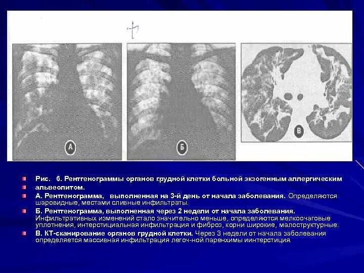 Умеренные фиброзные изменения