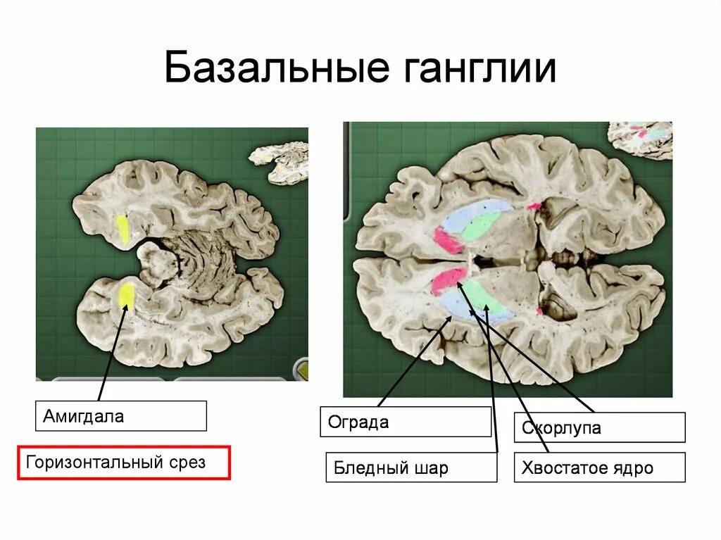 Базальные ганглии конечного мозга. Базальные ганглии горизонтальный срез. Базальные ганглии ядра. Бледный шар скорлупа хвостатое ядро. Изменение в базальных отделах