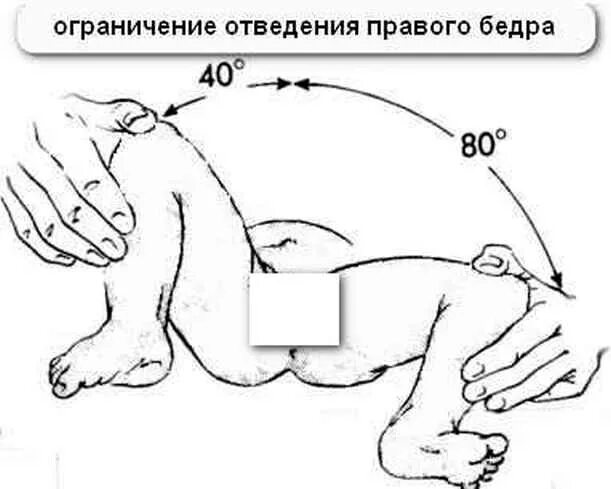 Дисплазия сустава у новорожденного лечение. Ограничение отведения бедра у грудничка. Ограничение отведения бедра при дисплазии. Ограничение отведения в тазобедренных суставах. У новорожденных дисплазия тазобедренного сустава новорожденных.