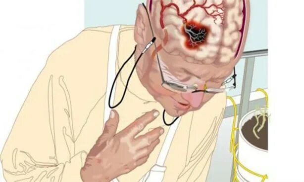 Инсульт кома выживают. Микроинсульт лобной доли. Кровоизлияние в головной мозг.