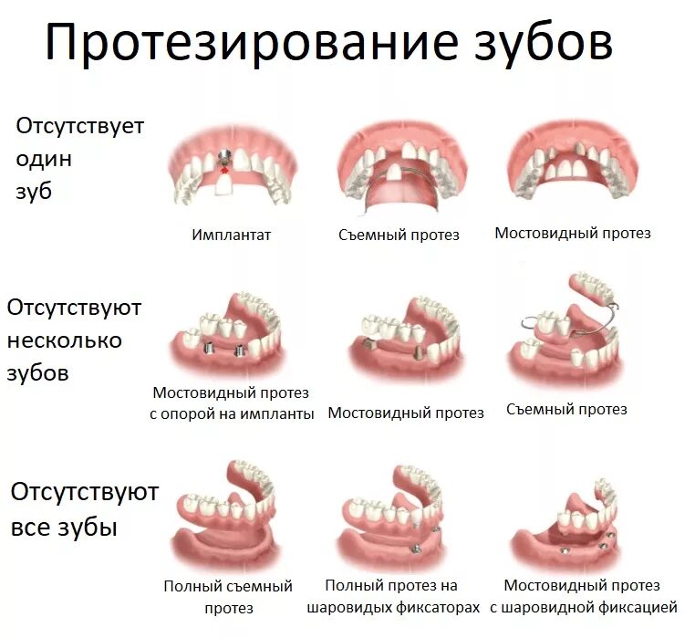 Классификация несъемных протезов ортопедическая стоматология. Какие виды съемных протезов бывают. Виды съемных конструкций зубных протезов. Классификация съемных протезов ортопедическая стоматология. Можно ли лечить зубы на ранних сроках