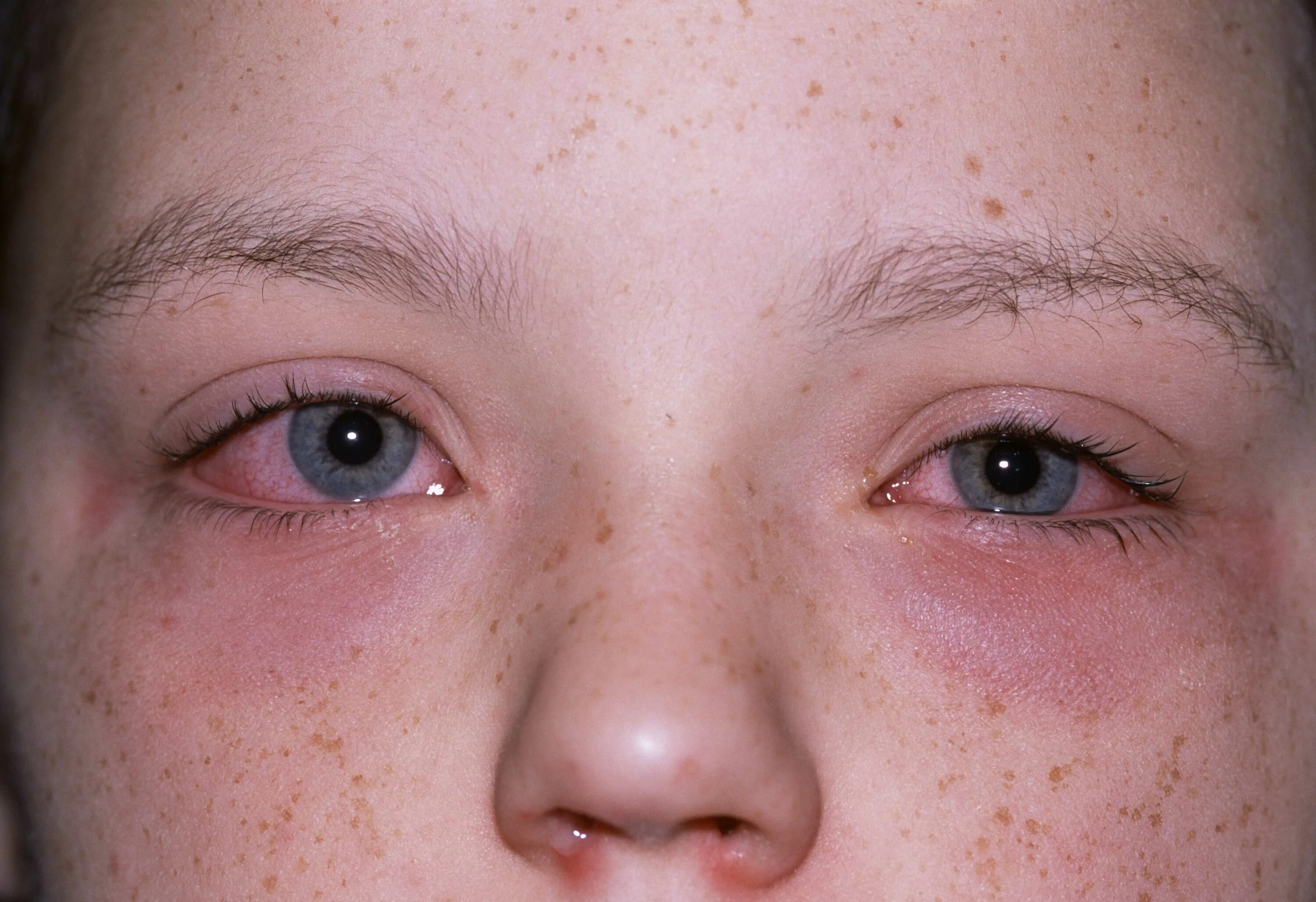 Мелкие кровоизлияния на лице. Точечные кровоизлияния. Что такое корем