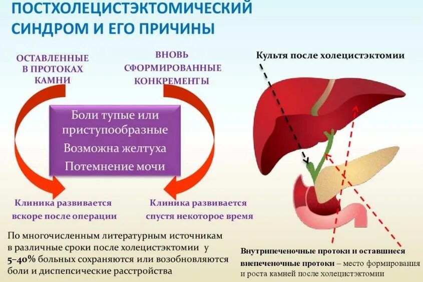 После удаления желчного пузыря. Причины, вызывающие постхолецистэктомический синдром. Постхолецистэктомический синдром желчекаменная болезнь. Клиника постхолецистэктомический синдром симптомы. Постхолецистэктомический синдром классификация.