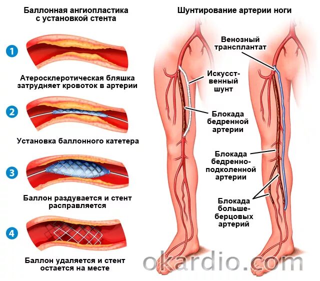 Шунтирование атеросклероза. Баллонная ангиопластика артерий нижних конечностей ход операции. Шунт артерии нижних конечностей. Атеросклероз артерий нижних конечностей (синдром Лериша).