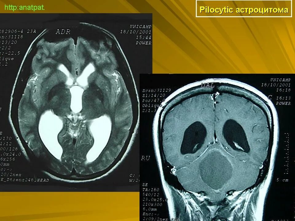 Пилоидная астроцитома. Пилоцитарная астроцитома. Пилоцитарная астроцитома мрт. Пилоцитарная астроцитома кт.