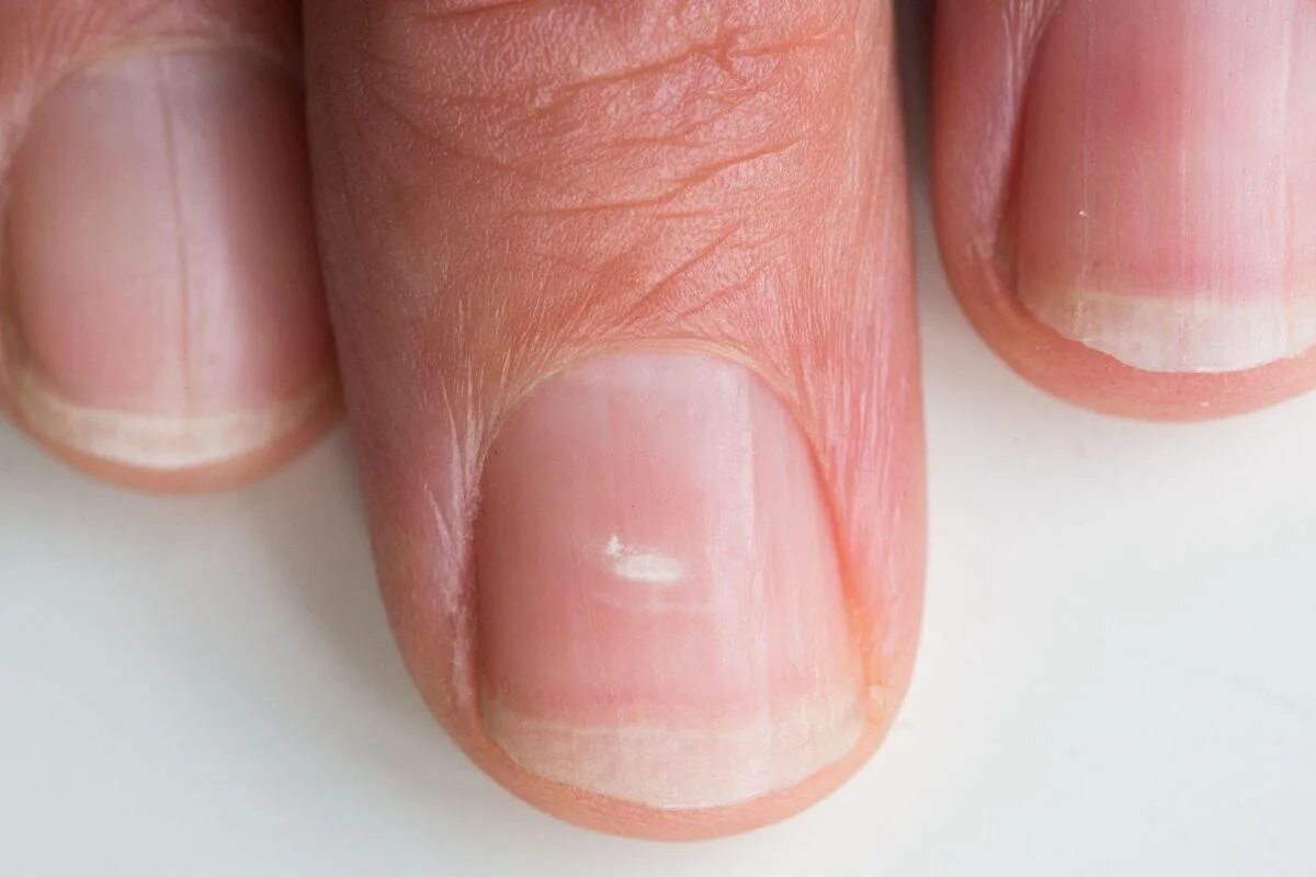 Почему на ногтях появляются продольные. Ониходистрофия, лейконихия. Микотическая лейконихия. Лейконихия белые пятна на ногтях.