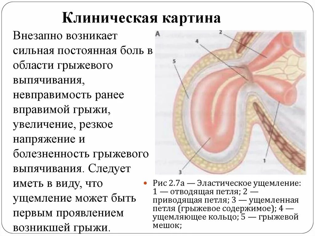 Клиническая картина ущемленной грыжи. Эластическое ущемление грыжи обусловлено. Клинический симптом ущемленной грыжи. Ущемленная грыжа живота.