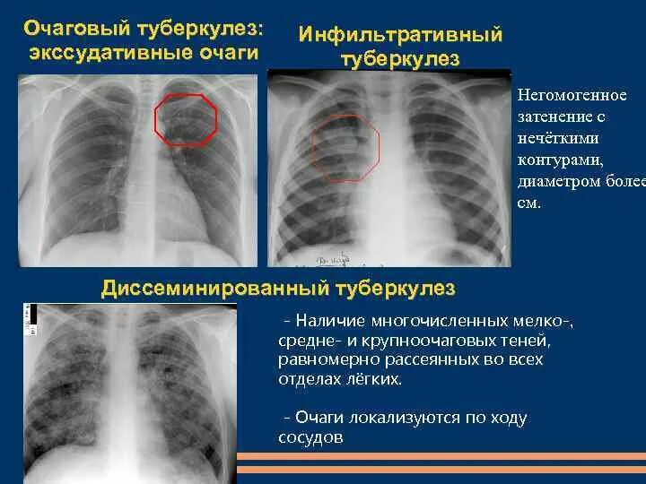 Округлое затемнение