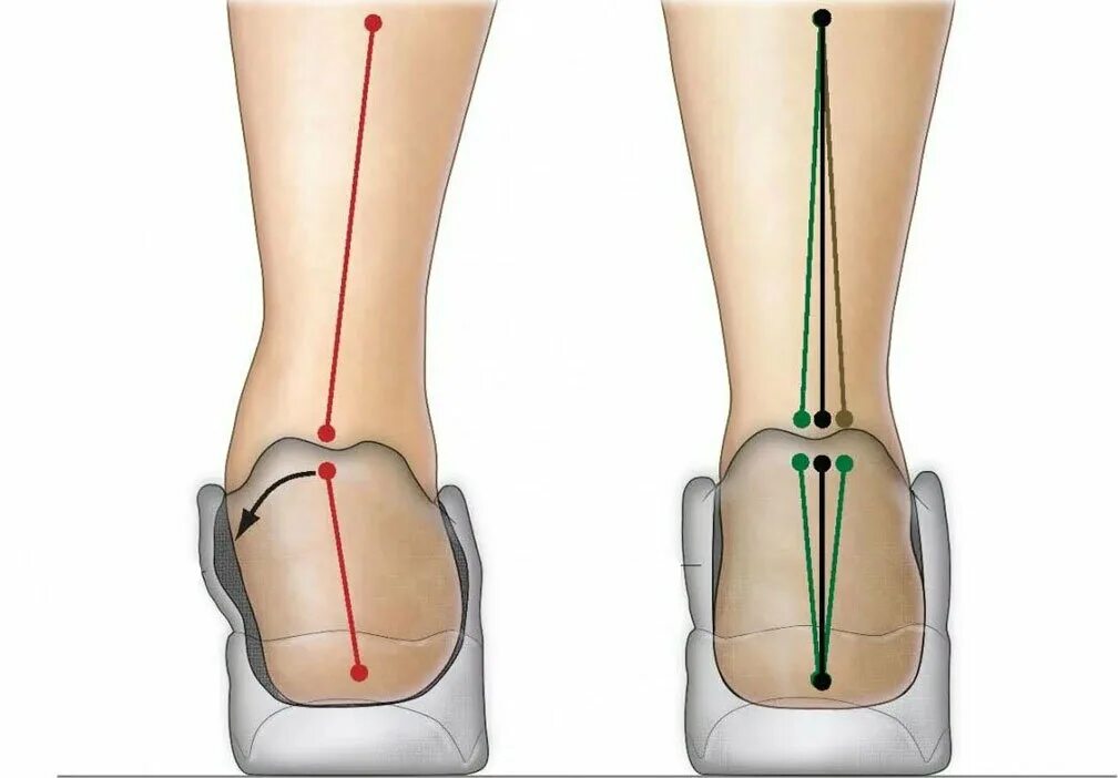 Варусная и вальгусная деформация стоп. Пронация и супинация стопы. Варусная деформация голеностопного сустава. Операция на стопы обувь