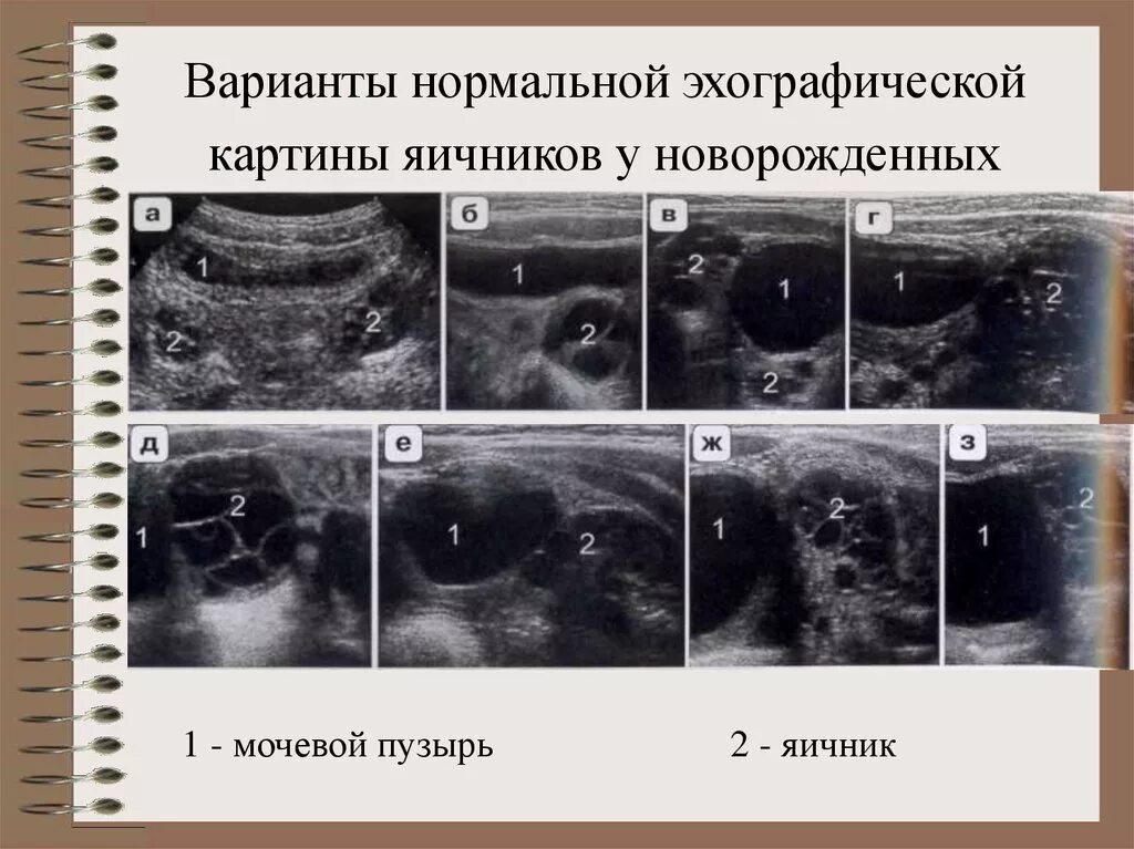 Яичники на УЗИ норма. Норма правого яичника