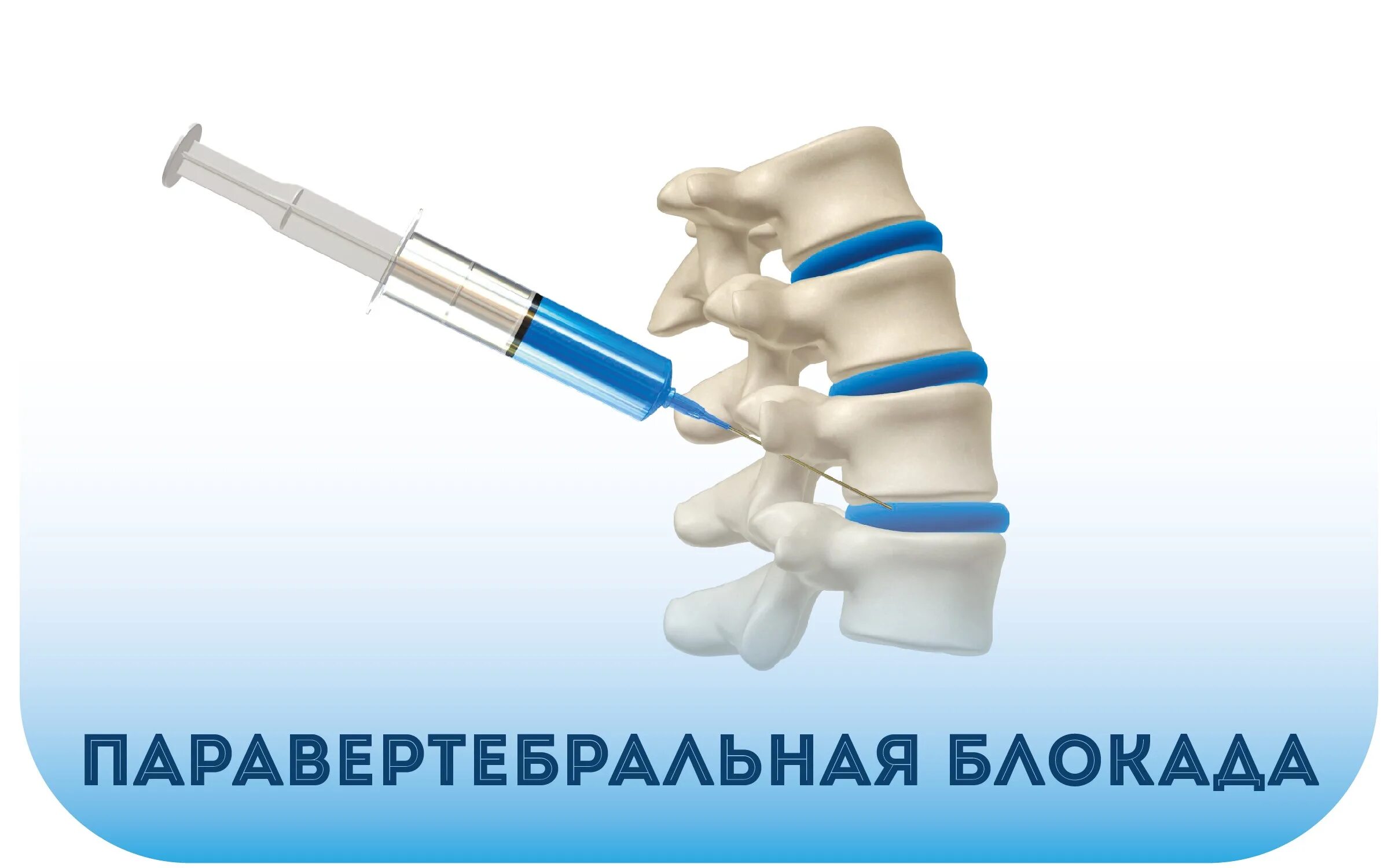 Блокада уколами поясницу. Блокада для спины уколы препараты. Лекарство для блокады позвоночника. Блакада для спины припараты.