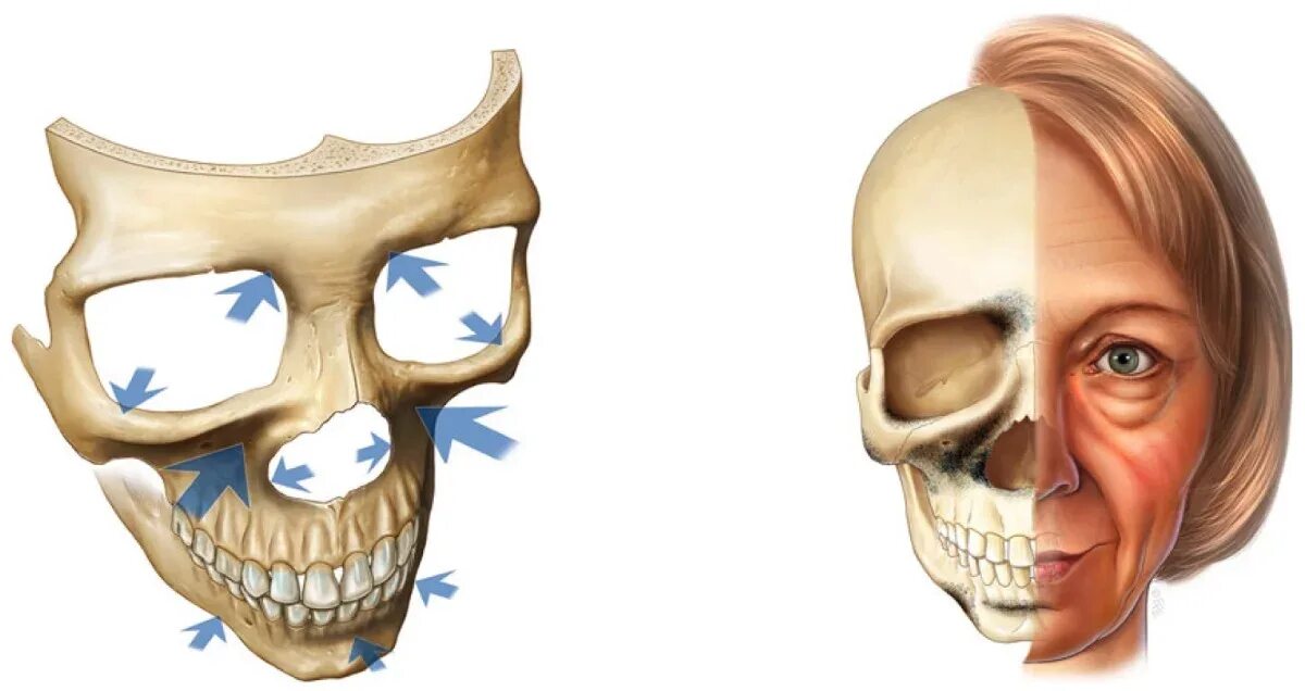 Основным признаком возрастных изменений костей. Bryan Mendelson изменение лицевого скелета. Резорбция костной ткани черепа. Резорбция кости челюсти.