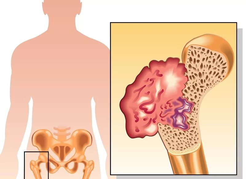 Саркома тазобедренного. Остеосаркома тазобедренного сустава. Остеогенная саркома кости. Саркома костной ткани симптомы.