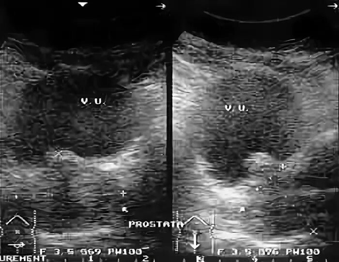 Узел в простате. Эхогенность предстательной железы. Аденоматозный узел предстательной железы при ультразвуковом. Аденоматозный узел предстательной железы при УЗИ.