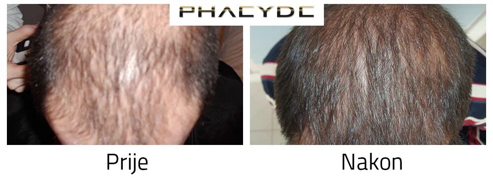 За сколько отрастают волосы у мужчин. Через месяц после пересадки волос. Пигментация после пересадки волос. Донорская зона после пересадки волос.