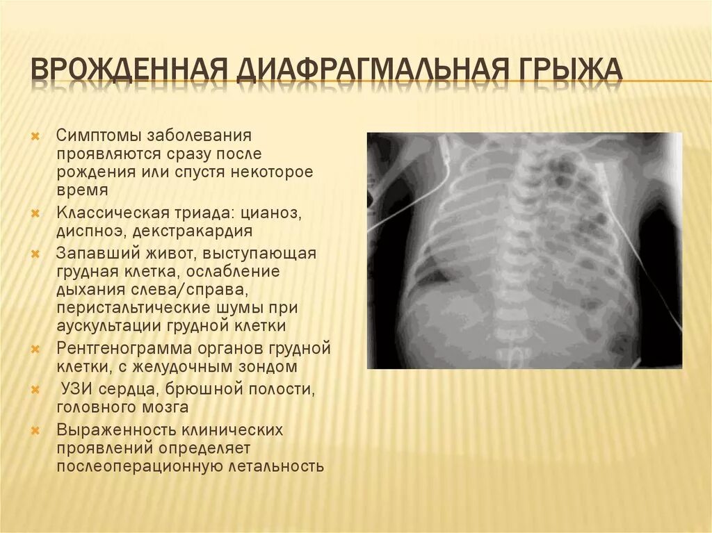 Диагностика диафрагмальной грыжи