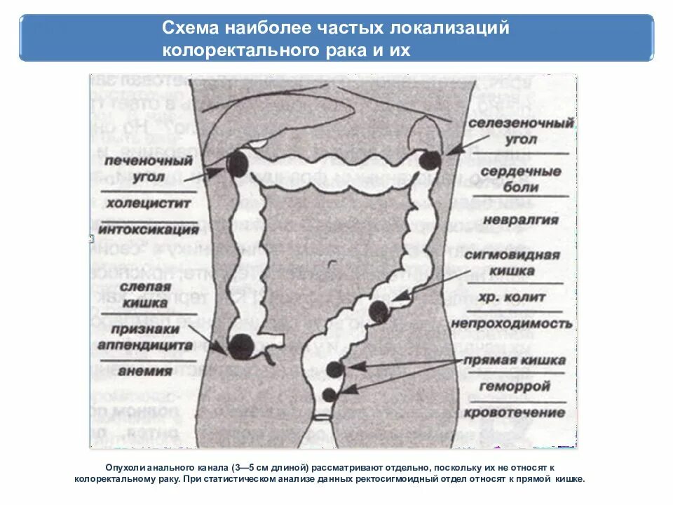 Ректосигмоидный отдел сигмовидной кишки. Новообразование ректосигмоидного соединения. Опухоль прямой кишки схема. Колоректальной карциномы. Онкология прямой кишки стадии