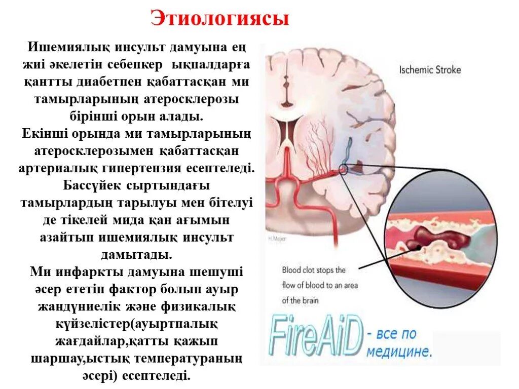 Где находится инсульт. Презентация на тему инсульт. Ишемический инсульт презентация.