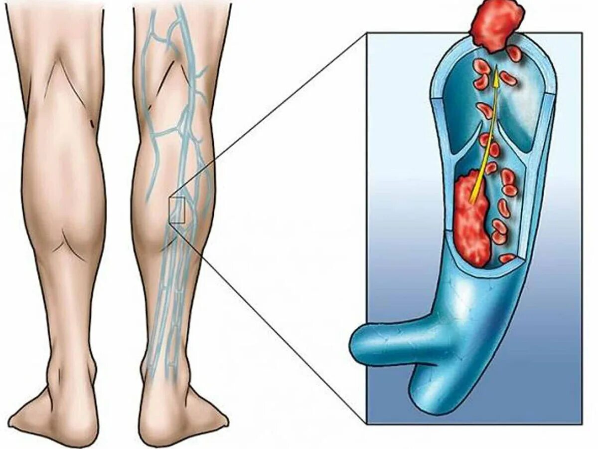 Причины тромбов симптомы. Венозный тромбоз глубоких вен нижних конечностей. Илеофеморальный венозный тромбоз. Варикозное расширение вен (ВРВ) нижних конечностей.