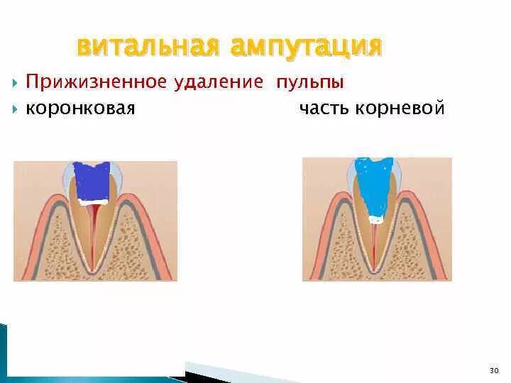 Витальная ампутация пульпы. Пульпит метод витальной ампутации. Девитальная ампутация пульпы методика. Витальная ампутация пульпы методика. Витальная экстирпация пульпы методика.