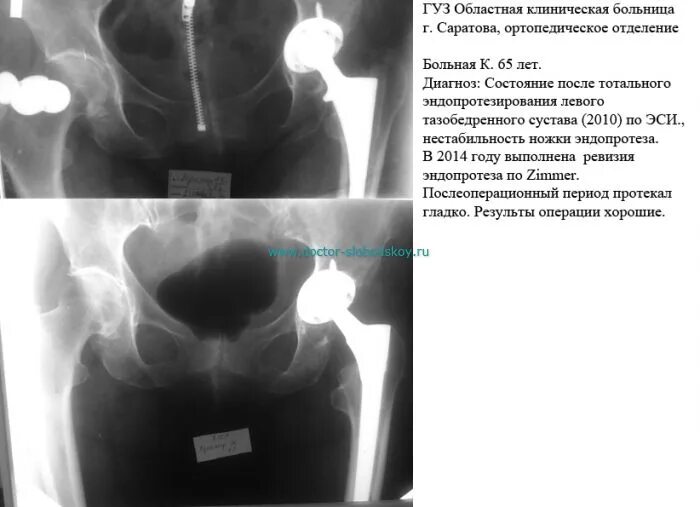Мрт после эндопротезирования. Нестабильность чашки эндопротеза тазобедренного сустава кт. Эндопротезирование тазобедренного сустава описание рентгенограммы. Описание рентгенограммы эндопротеза тазобедренного сустава. Состояние после эндопротезирования тазобедренного сустава рентген.
